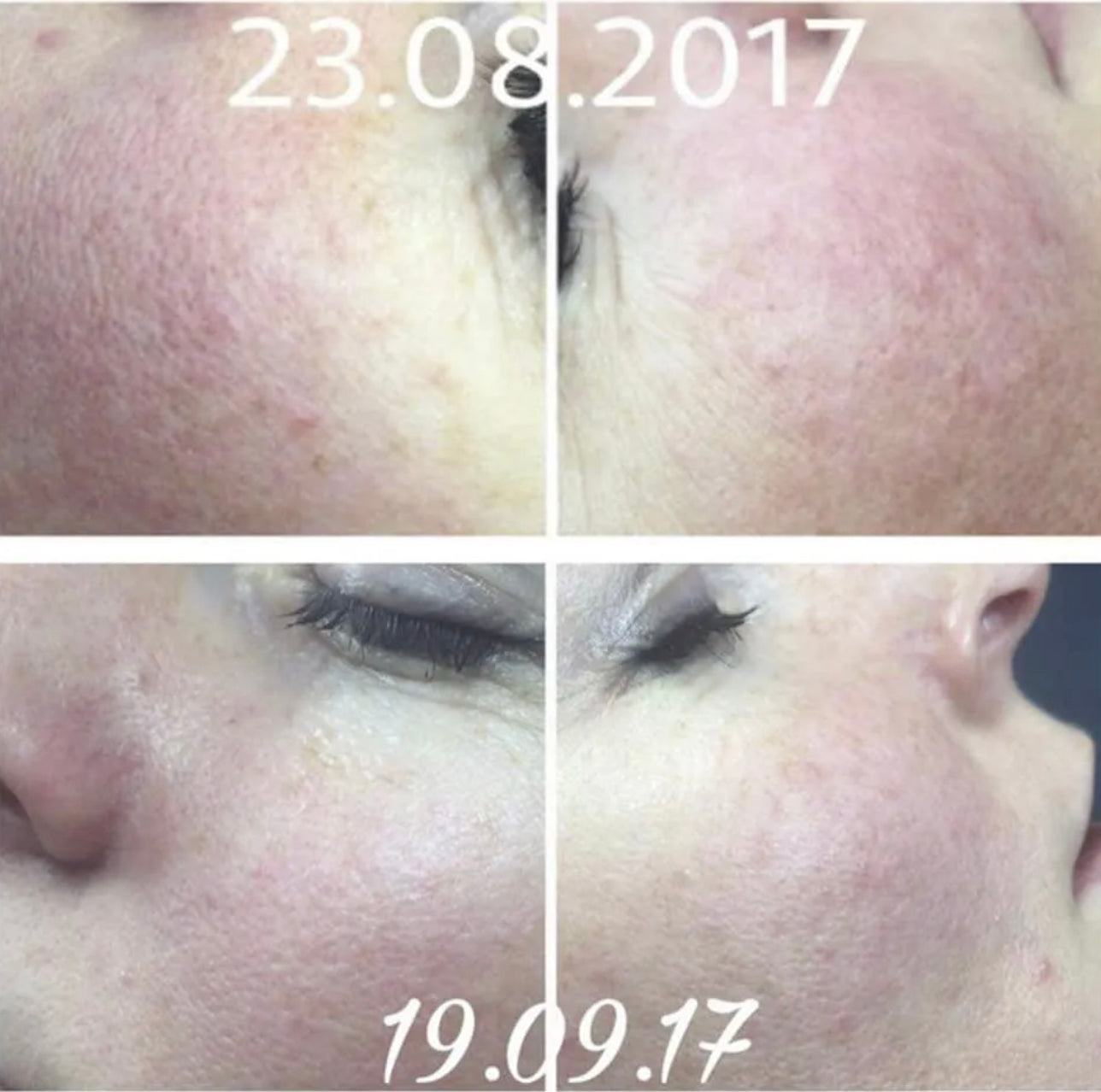 DR.E.VOSS HYA 4 CAPIMED Couperose Serum 30ml