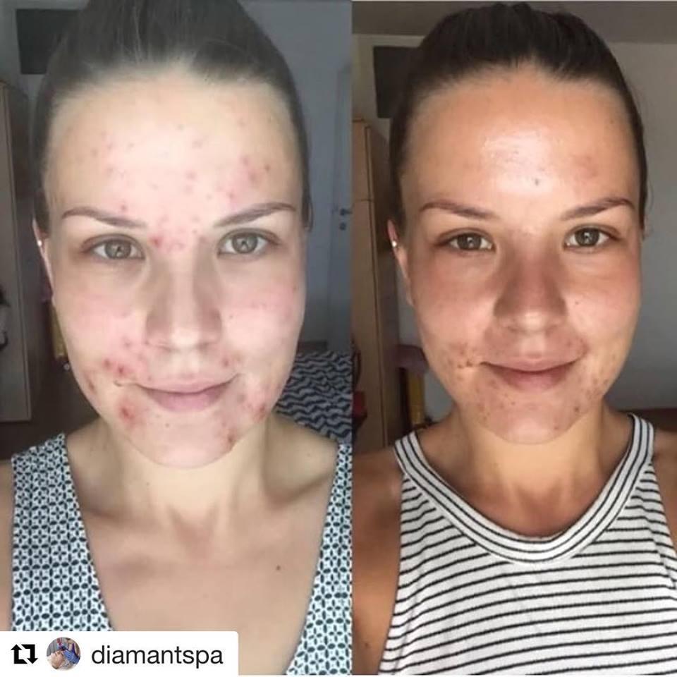 Dr.E.Voss Top Peel Set 1 bei unreiner Haut - Mamaladen GmbH