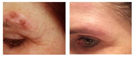 Dr.E.Voss Top Peel Set 2 Spot/Pigmentflecken - Mamaladen GmbH